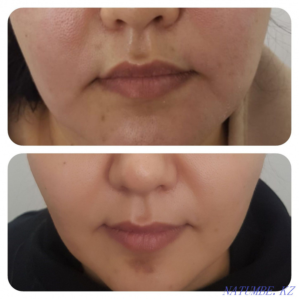 Омоложение и лечение! Холодная плазма!!! Блефаропластика! Астана - изображение 3