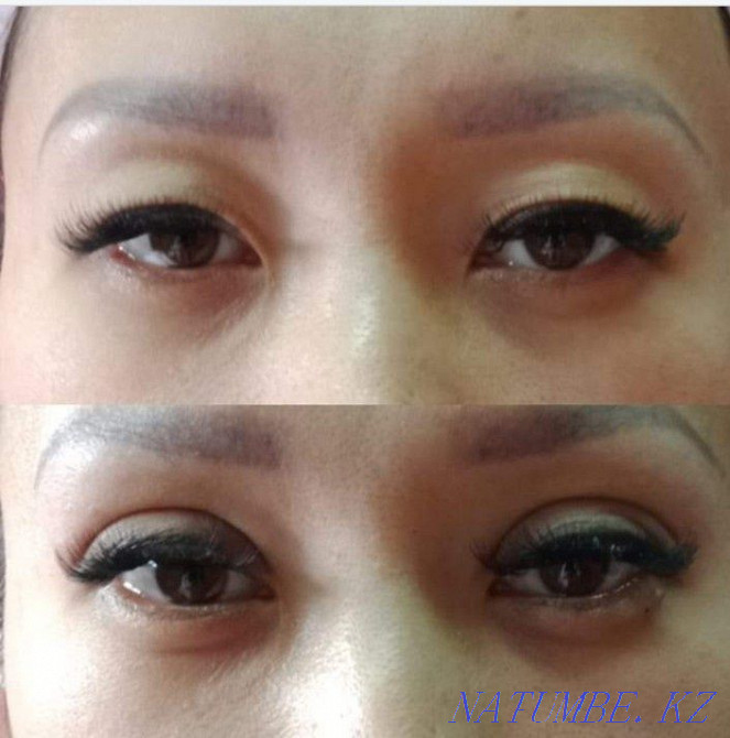 Sangapuri, Thread Blepharoplasty Model Required Temirtau - photo 1