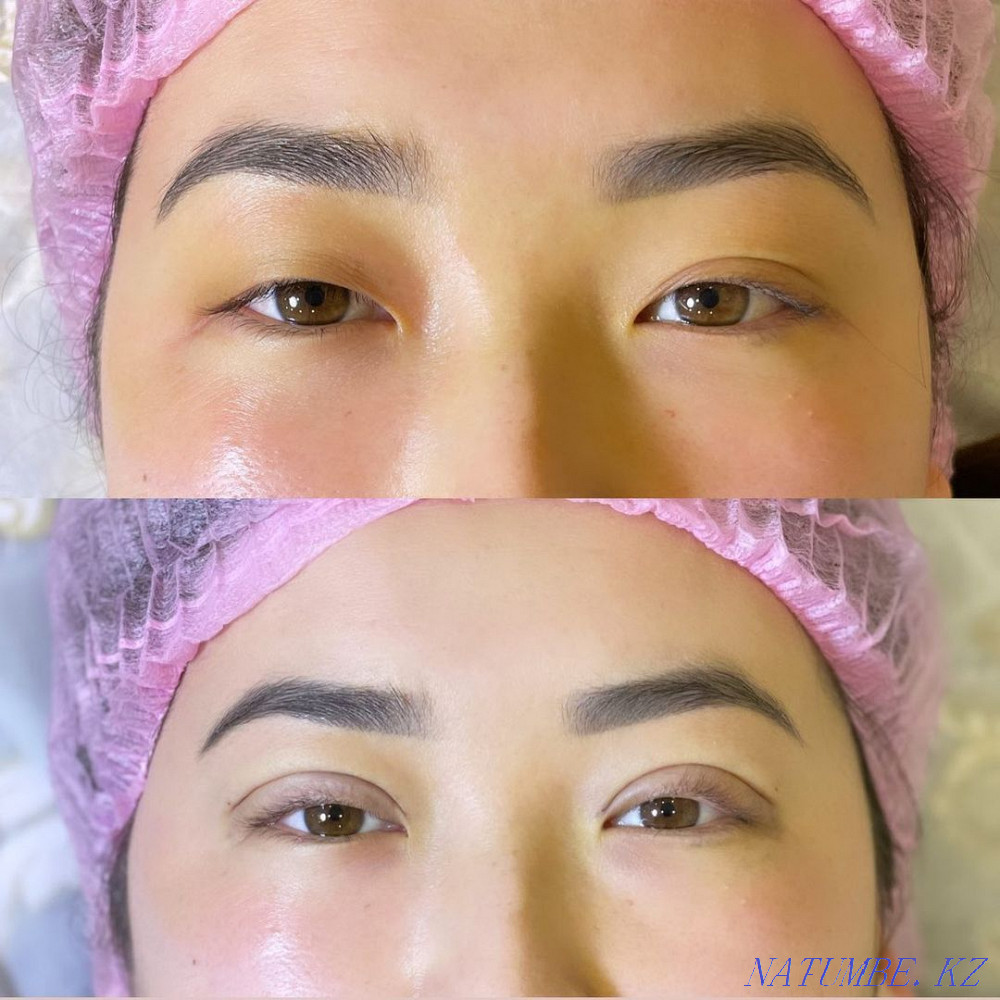 Нитевая блеферопластика  - изображение 1