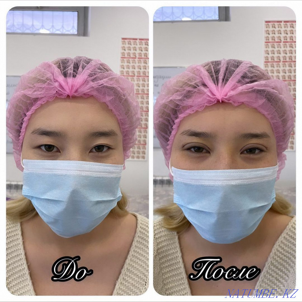 Нитевая блеферопластика  - изображение 2