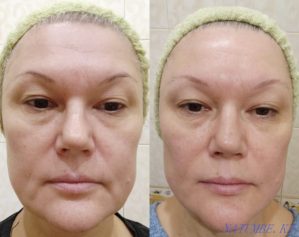 Hardware cosmetology Ust-Kamenogorsk - photo 5