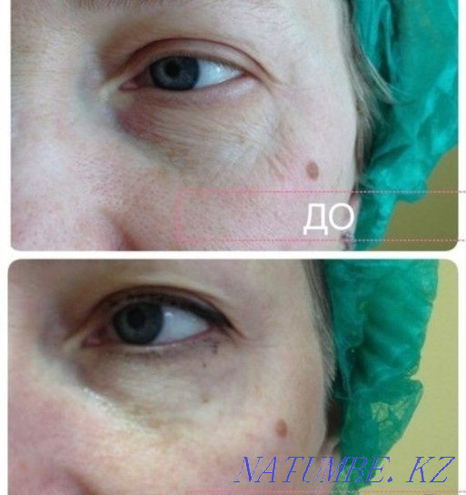 Hardware cosmetology Ust-Kamenogorsk - photo 4