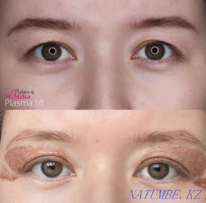 Blepharoplasty Almaty - photo 2