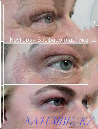 Tattoo, Cleaning, Blepharoplasty, BbGlow, Mole RemovalPapilloma Stretch Marks Shymkent - photo 7