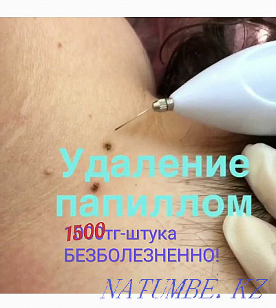 Tattoo, Cleaning, Blepharoplasty, BbGlow, Mole RemovalPapilloma Stretch Marks Shymkent - photo 6