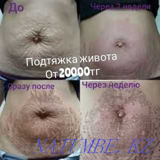 Tattoo, Cleaning, Blepharoplasty, BbGlow, Mole RemovalPapilloma Stretch Marks Shymkent - photo 3