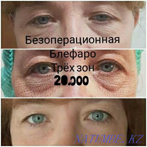 Tattoo, Cleaning, Blepharoplasty, BbGlow, Mole RemovalPapilloma Stretch Marks Shymkent - photo 8