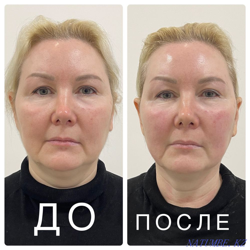 Promotion for Smas lifting 50% Almaty - photo 3