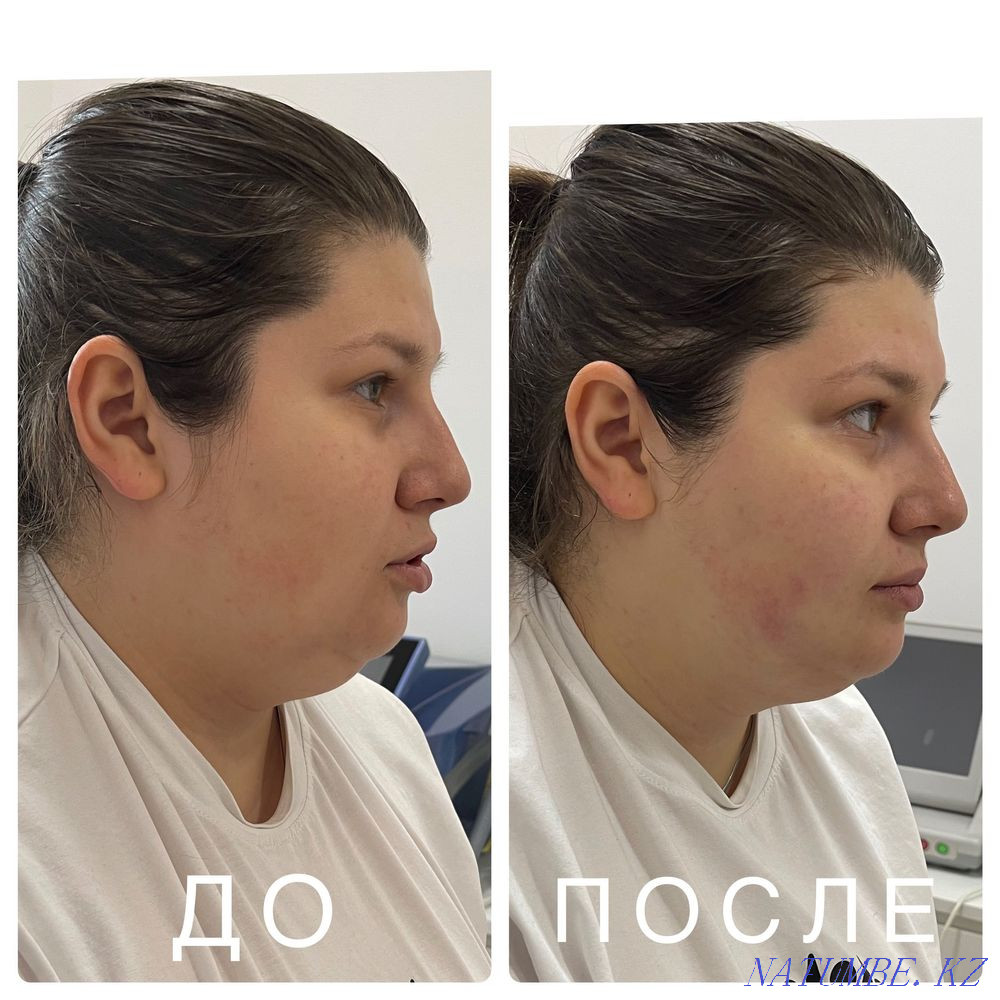 Promotion for Smas lifting 50% Almaty - photo 4