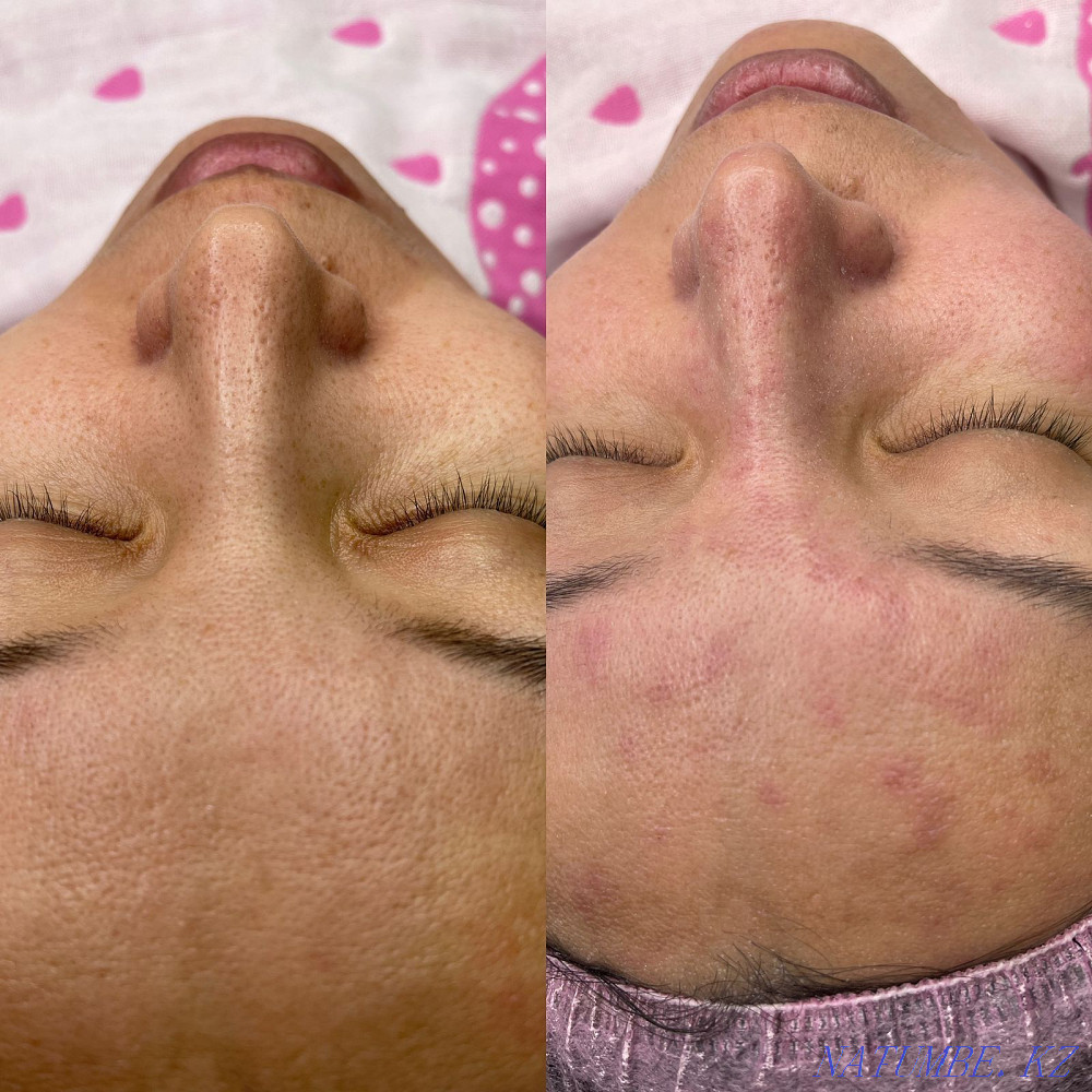 Косметолог Чистка лица Караганда - изображение 4