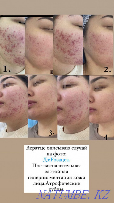 Чистка лица косметология Караганда - изображение 1