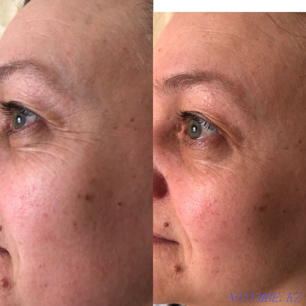 Чистка Комбинированная Пилинги Массажи лица ! Караганда - изображение 4