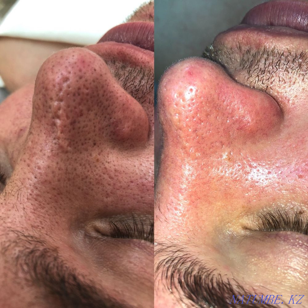 Чистка Комбинированная Пилинги Массажи лица ! Караганда - изображение 1