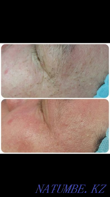 Facial cleansing cosmetologist Karagandy - photo 4
