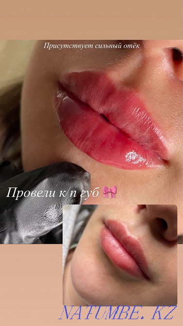 Контурная пластика (увеличение) губ Алматы - изображение 4