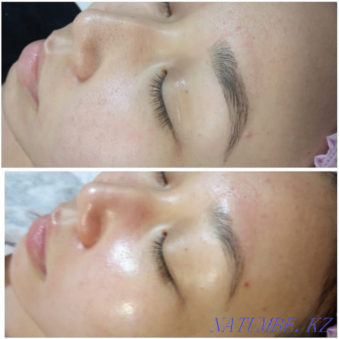 Face cleaning Almaty - photo 2