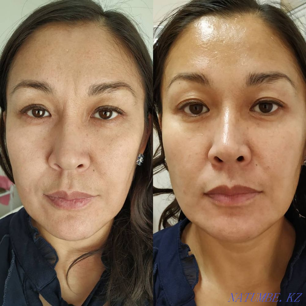 Чистка лица Алматы - изображение 4