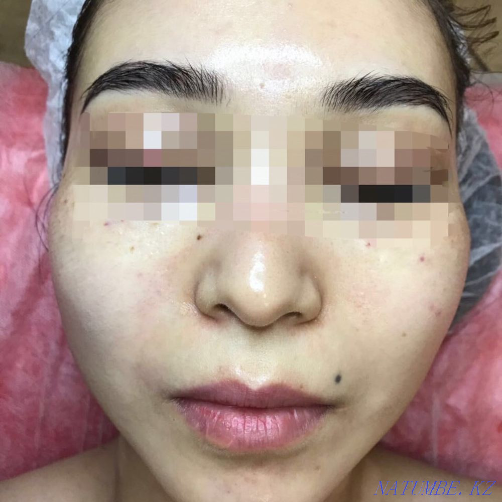 Чистка лица Алматы - изображение 3