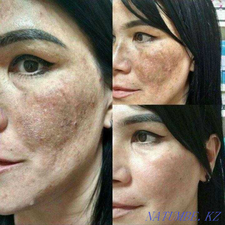 Чистка от пигментных пятен и акне,убираем возрастные изменения Астана - изображение 3