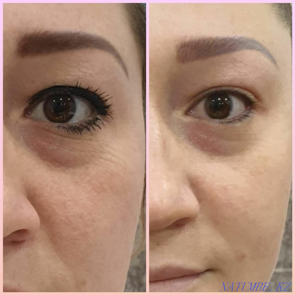 Чистка от пигментных пятен и акне,убираем возрастные изменения Астана - изображение 2