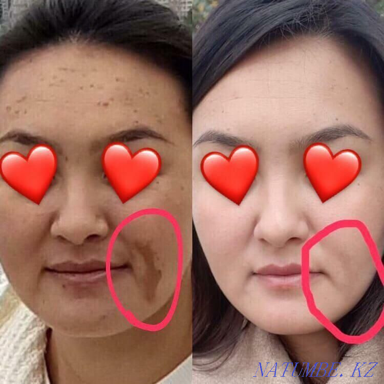 Чистка от пигментных пятен и акне,убираем возрастные изменения Астана - изображение 6