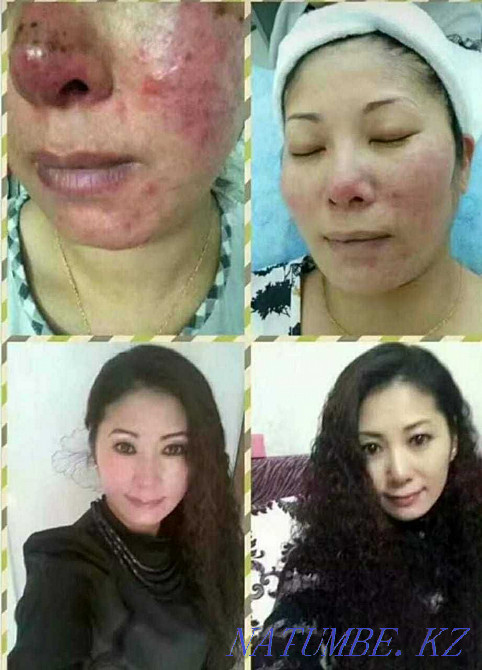 Чистка от пигментных пятен и акне,убираем возрастные изменения Астана - изображение 4