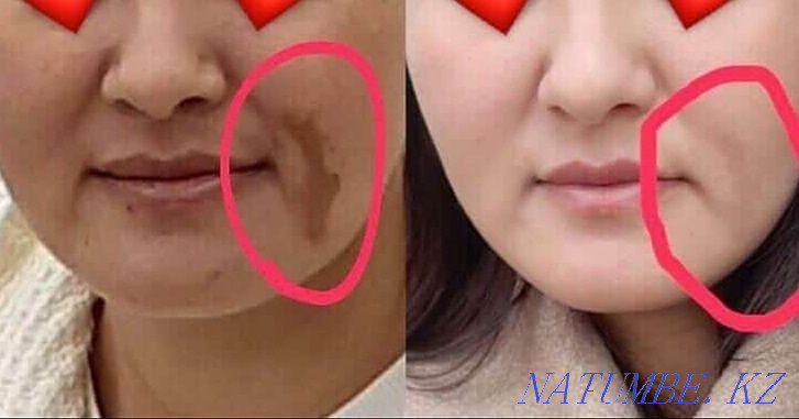 Чистка от пигментных пятен и акне,убираем возрастные изменения Астана - изображение 1