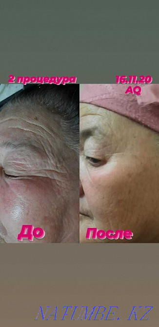 Чистка от пигментных пятен и акне,убираем возрастные изменения Астана - изображение 5