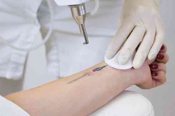 Удаление папилом татуировок пигментации Petropavlovsk