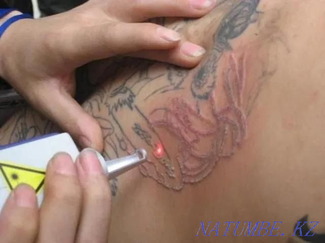 Pigmentation tattoo papillomas removal Petropavlovsk - photo 1