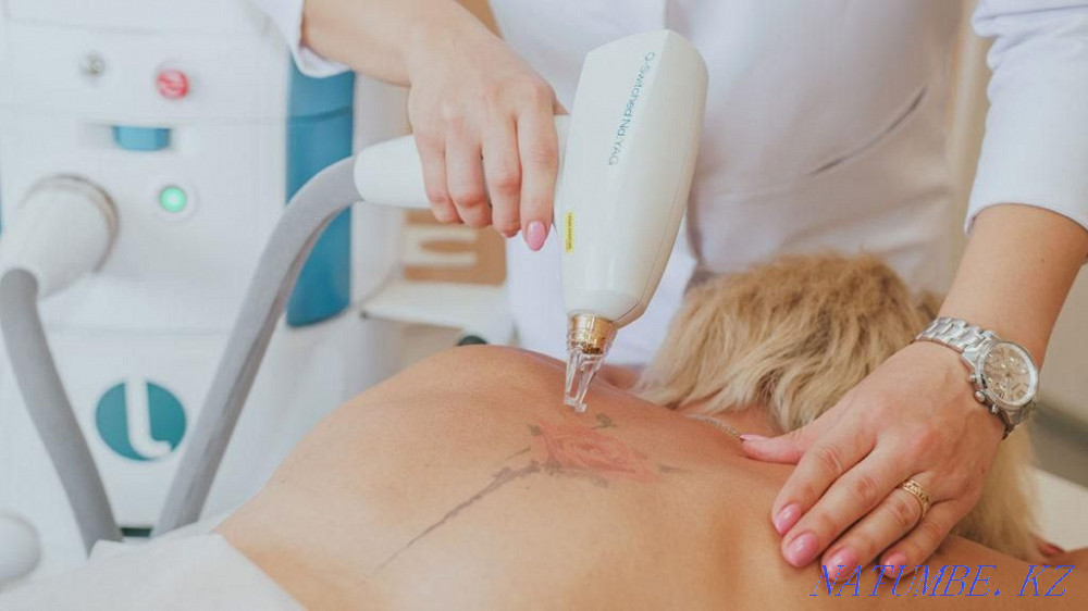 Pigmentation tattoo papillomas removal Petropavlovsk - photo 2