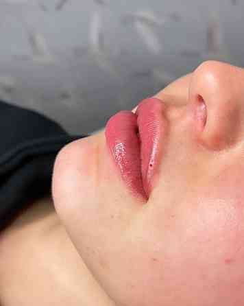 Увеличение губ, разглаживание носогубных складок Астана