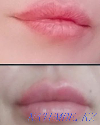 Stock. Lips, nasolabial botox, meso, hyperhidrosis. Astana - photo 4