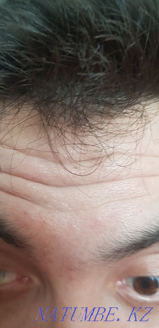 Акция. Губы, носогубки ботокс, мезо, гипергидроз. Астана - изображение 6