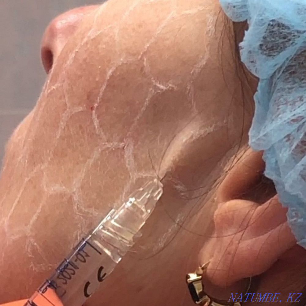 Акция. Губы, носогубки ботокс, мезо, гипергидроз. Астана - изображение 1