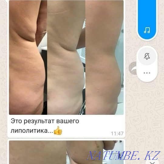 Акция. Губы, носогубки ботокс, мезо, гипергидроз. Астана - изображение 3