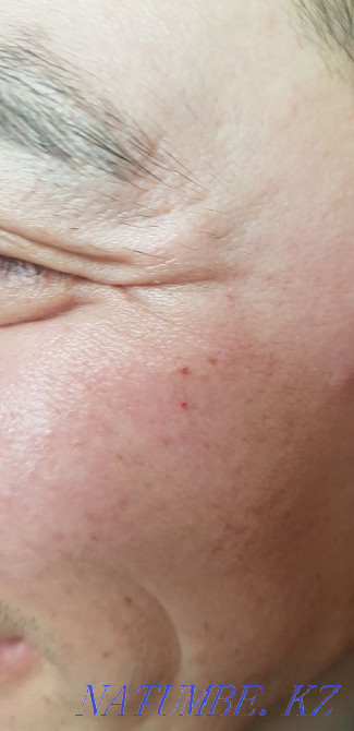 Акция. Губы, носогубки ботокс, мезо, гипергидроз. Астана - изображение 7