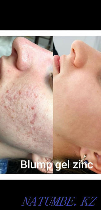 Акция. Губы, носогубки ботокс, мезо, гипергидроз. Астана - изображение 2