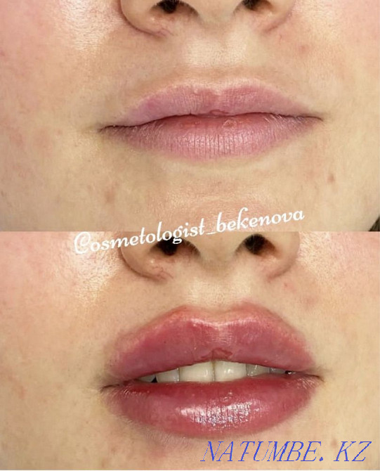 Увеличение губ Астана - изображение 1