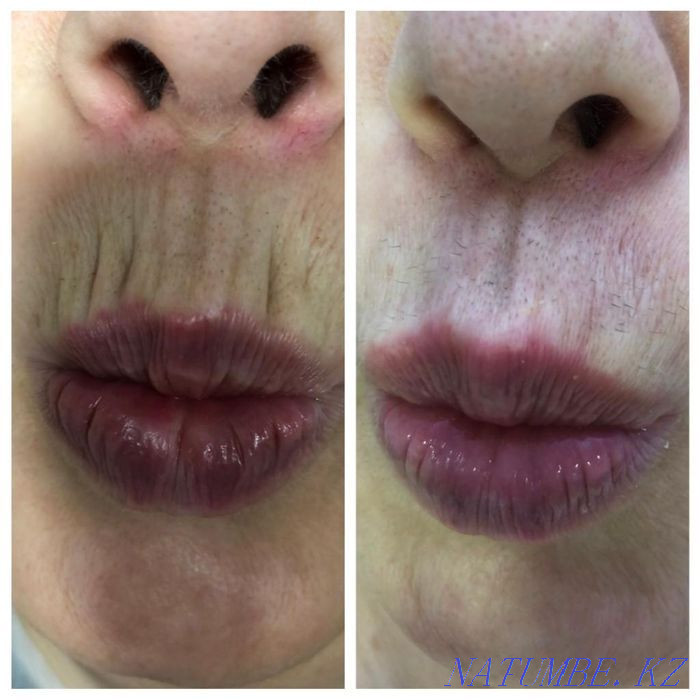 Гипергидроз.Губы.Похудение.Ботокс.Пирсинг.Морщины.Молодильное яблочко Астана - изображение 2