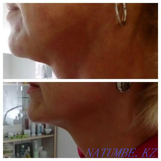 Гипергидроз.Губы.Похудение.Ботокс.Пирсинг.Морщины.Молодильное яблочко Астана - изображение 7