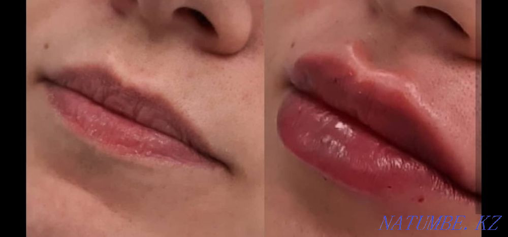 Гипергидроз.Губы.Похудение.Ботокс.Пирсинг.Морщины.Молодильное яблочко Астана - изображение 1