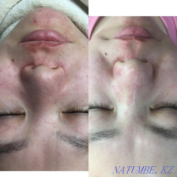 Гипергидроз.Губы.Похудение.Ботокс.Пирсинг.Морщины.Молодильное яблочко Астана - изображение 4