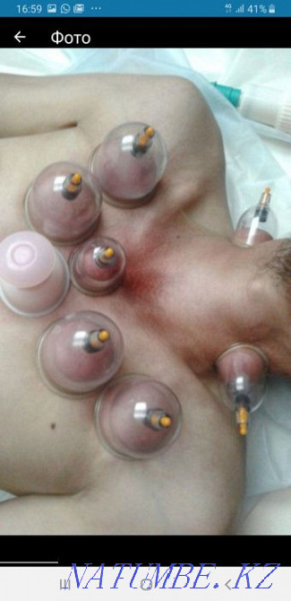 Гипергидроз.Губы.Похудение.Ботокс.Пирсинг.Морщины.Молодильное яблочко Астана - изображение 5