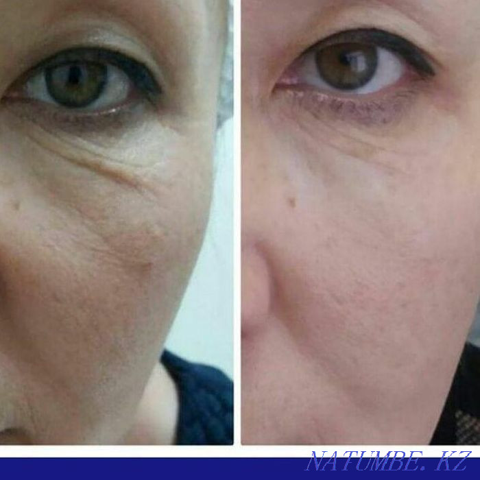 Гипергидроз.Губы.Похудение.Ботокс.Пирсинг.Морщины.Молодильное яблочко Астана - изображение 3