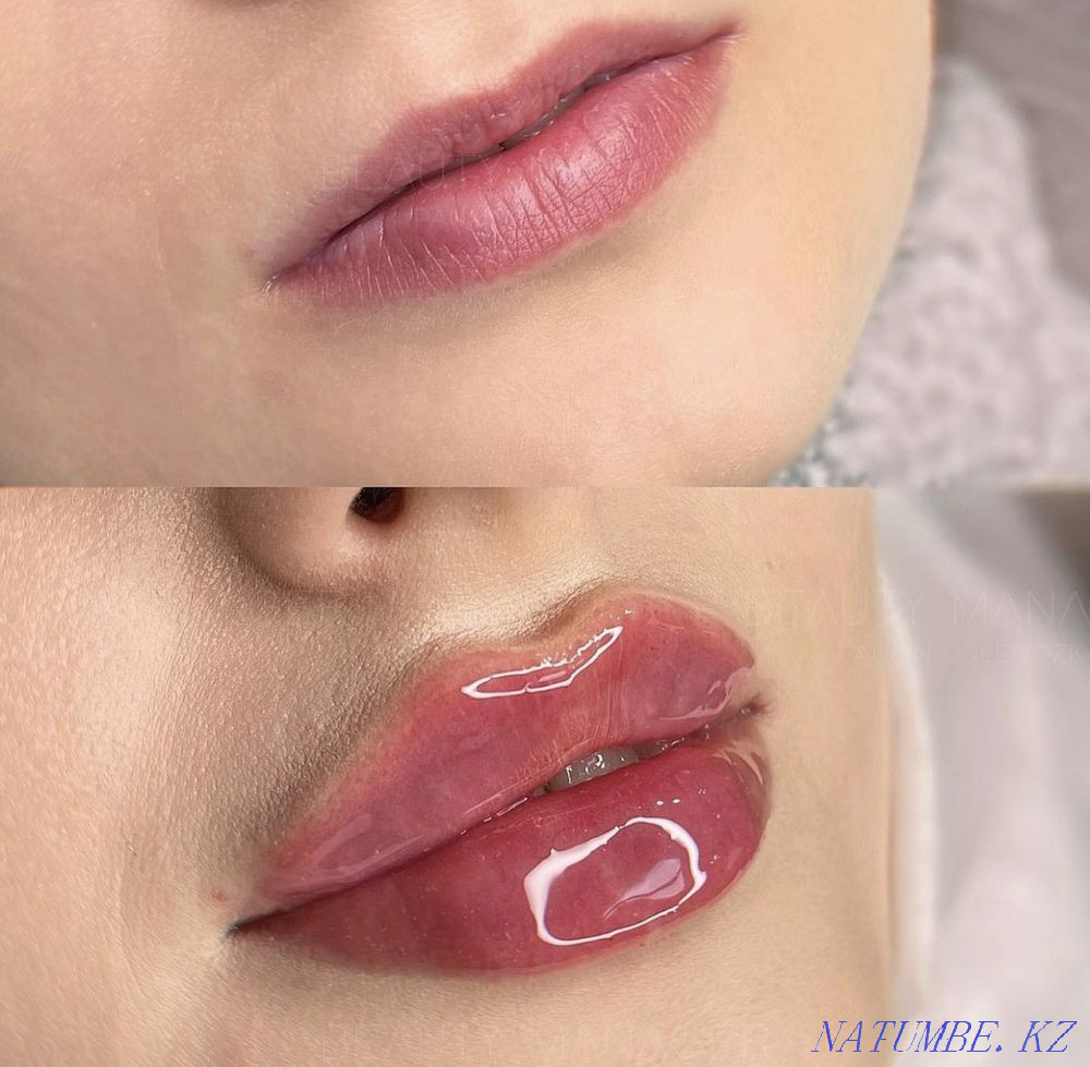 need models for lip augmentation 0.5ml-12000.1 ml -20000 tg Shymkent - photo 2