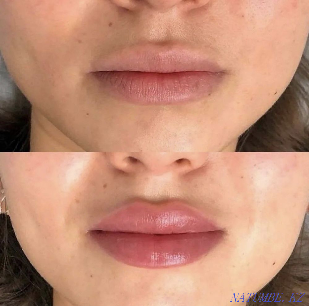 need models for lip augmentation 0.5ml-12000.1 ml -20000 tg Shymkent - photo 1