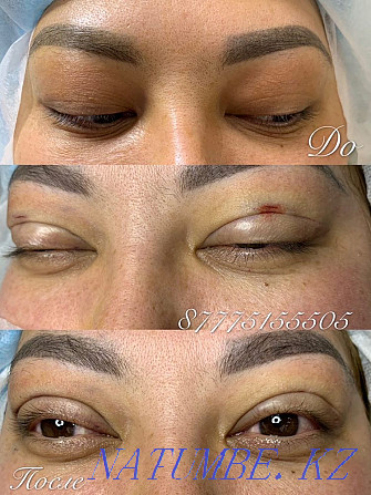 Eyelid blepharoplasty with Sangapuri threads Atyrau - photo 4