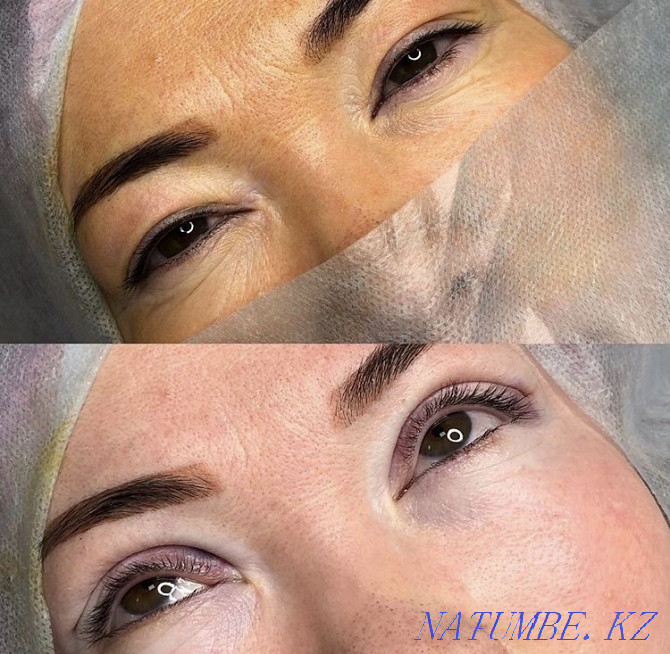 Eyelid blepharoplasty with Sangapuri threads Atyrau - photo 6