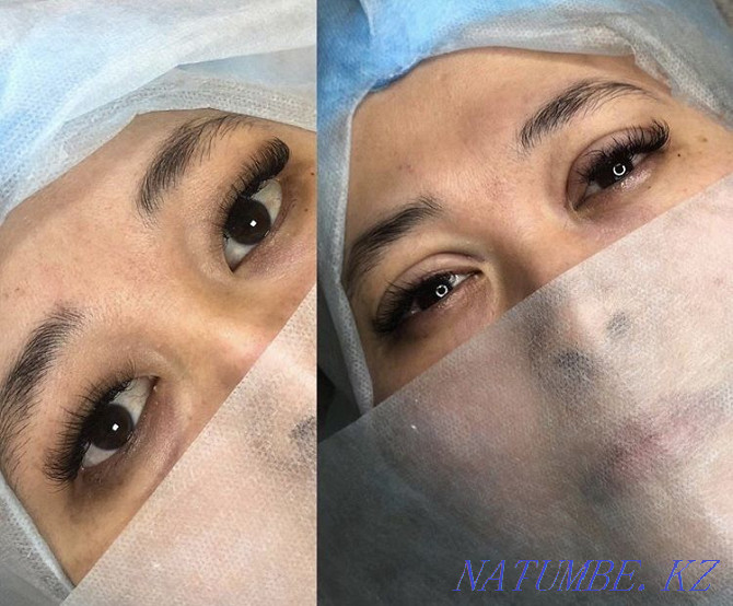 Eyelid blepharoplasty with Sangapuri threads Atyrau - photo 7